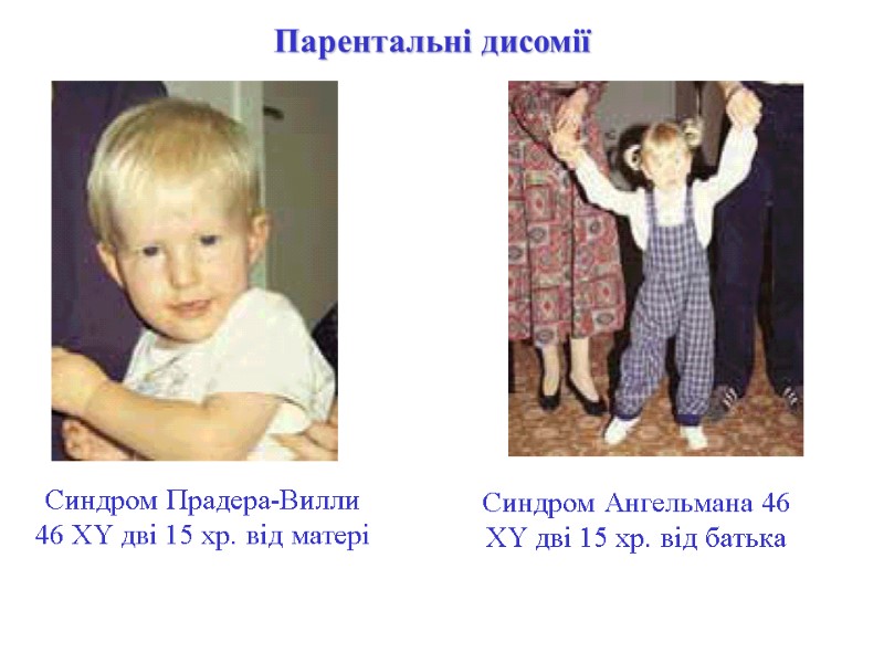 Синдром Прадера-Вилли 46 XY дві 15 хр. від матері Синдром Ангельмана 46 XY дві